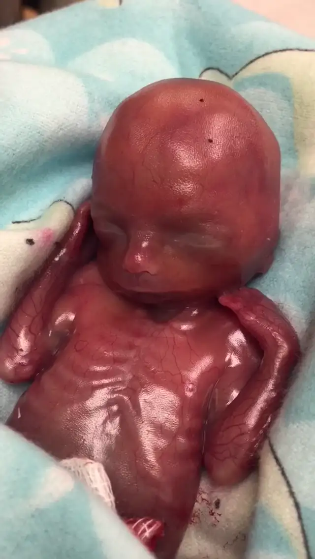 Rare footage of living 18-week miscarried baby
